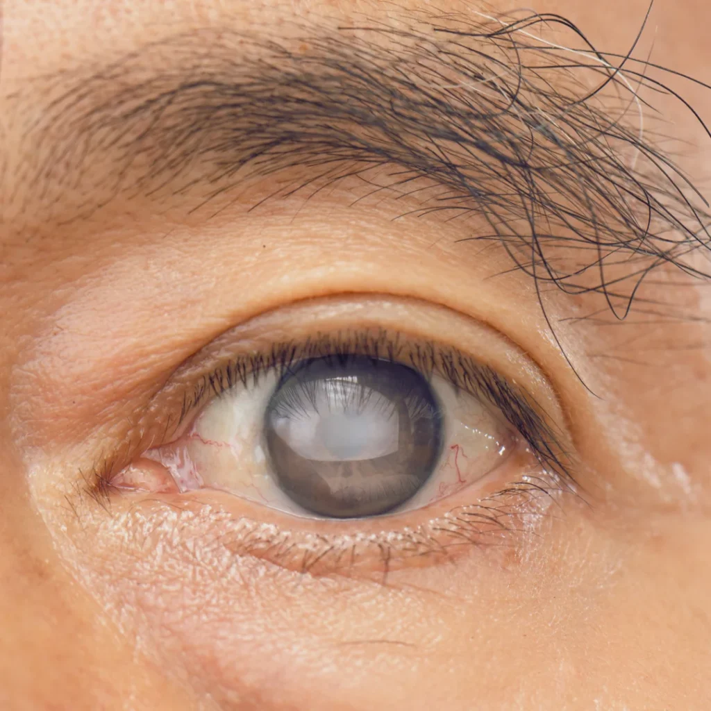 glaucoma and symptoms