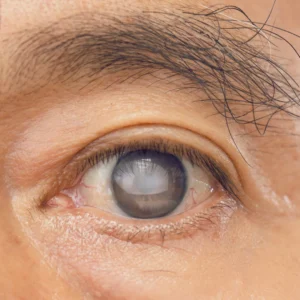 glaucoma and symptoms