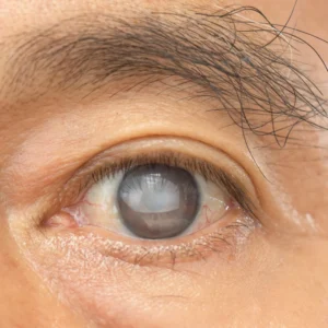What are cataracts?